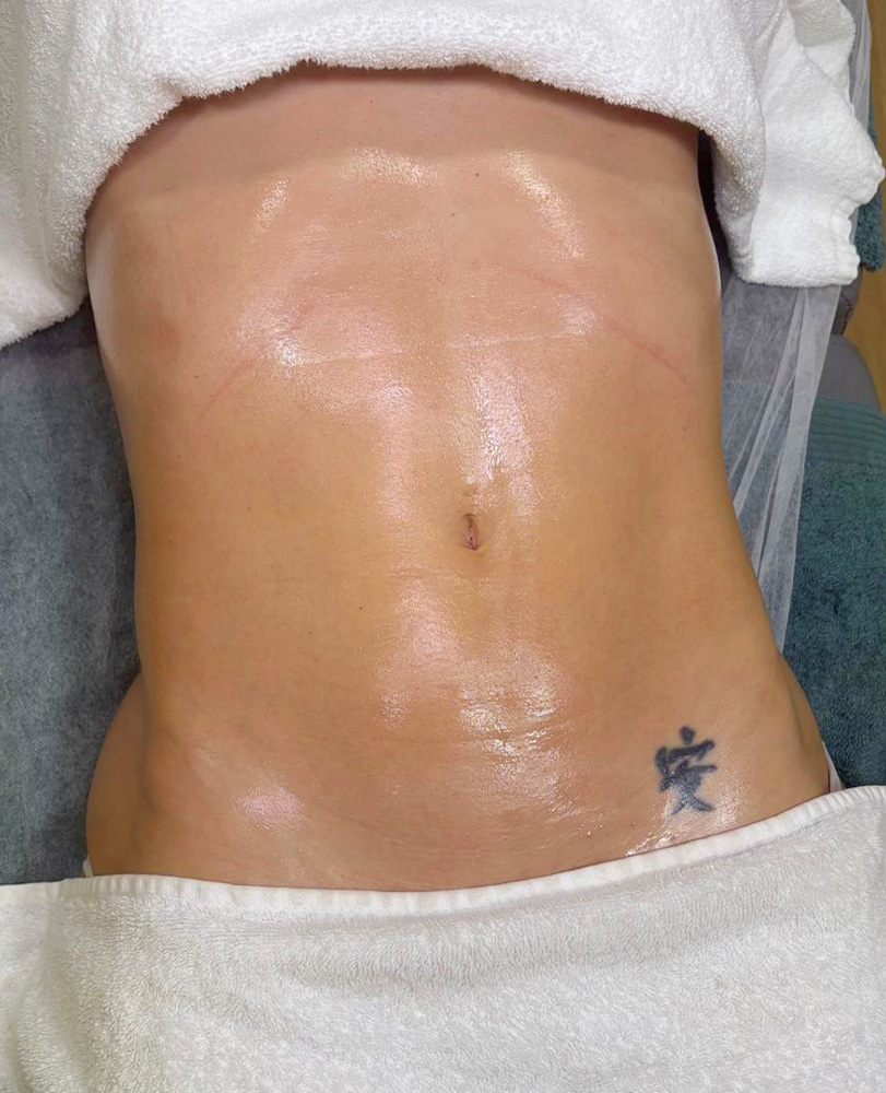 Después de drenaje linfático brasileño — resultado Cristel LUXO